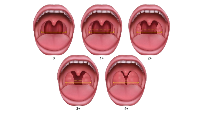 Pediatric Tonsillectomy and Adenoidectomy figure 2 4ga955 removebg preview