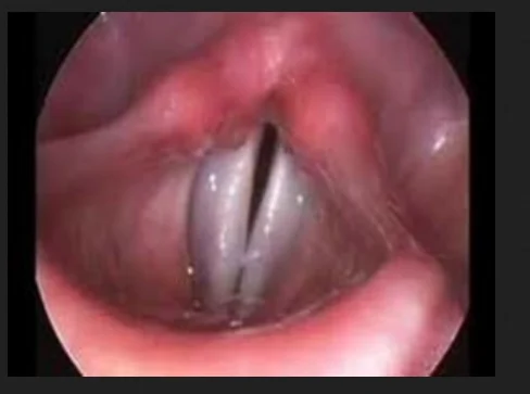 laryngoscopy 500x500 1