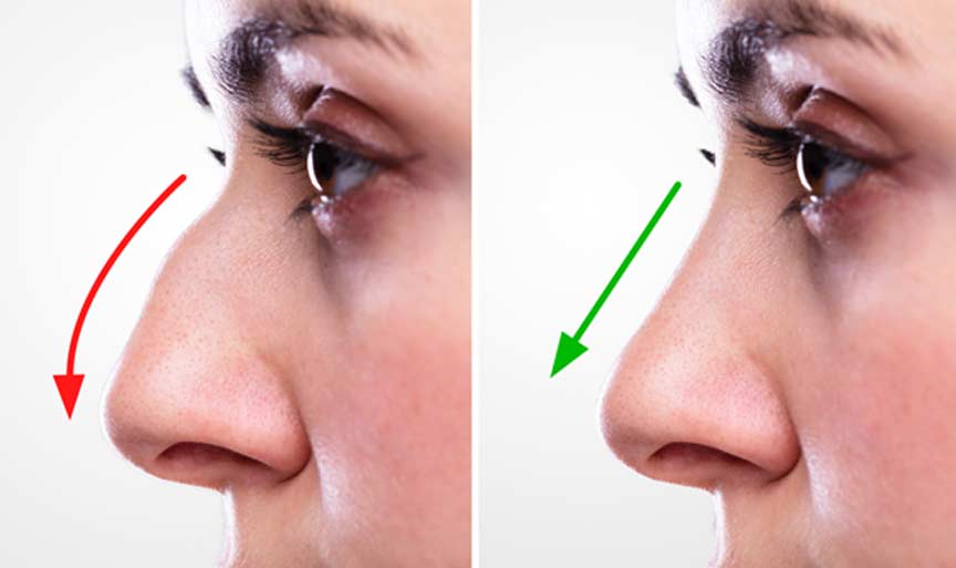patient after septorhinoplasty Nasal Sinus Surgery