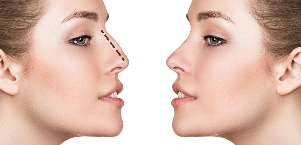 rhinoplasty min