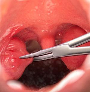 tonsillectomy adenoidectomy