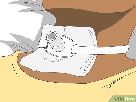 v4 460px Perform Tracheostomy Care Step 14 Version 4